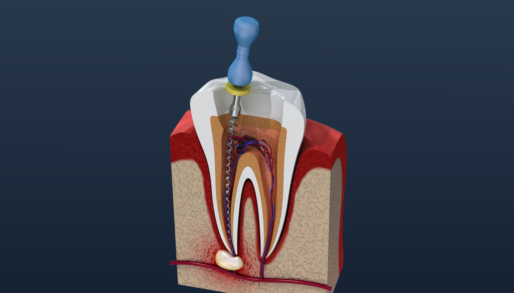 root canal treatment in besa