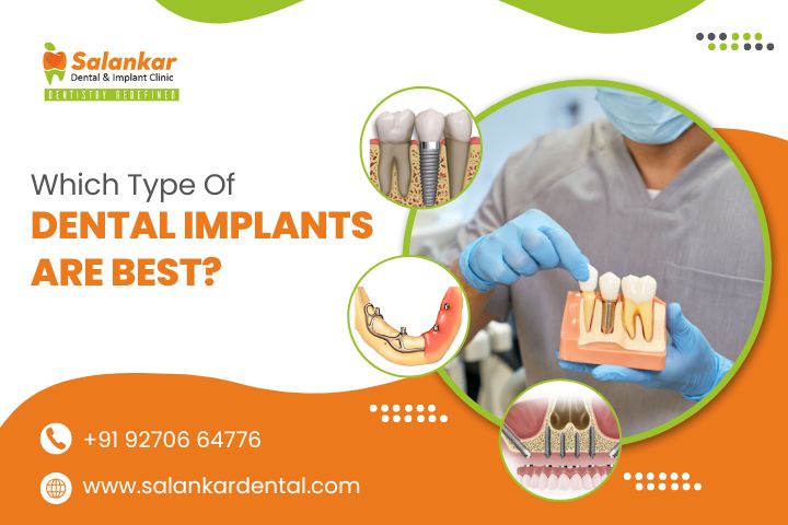 Which Type of Dental Implants Are Best?