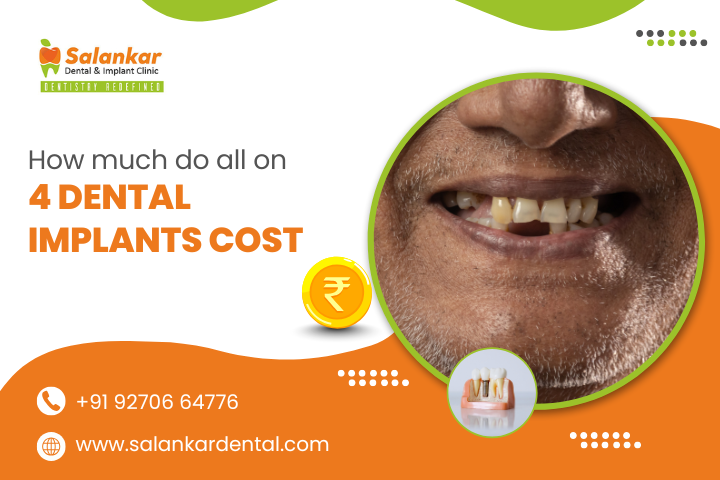 How Much Do All-on-4 Dental Implants Cost?