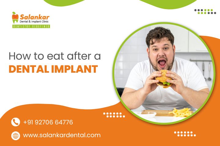 How to Eat After a Dental Implant
