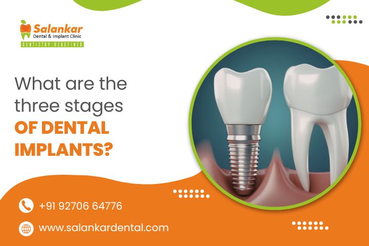 What Are The 3 Stages Of Dental Implants