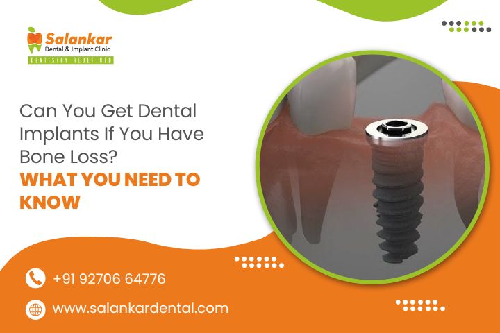 Can You Get Dental Implants If You Have Bone Loss? What You Need to Know